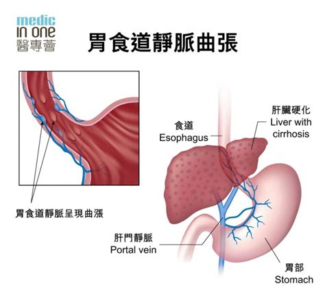 梁志明醫師|食道胃靜脈曲張硬化劑治療